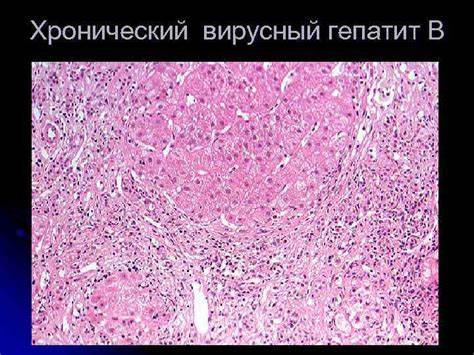 Хронический вирусный гепатит в диета Патология печени О А Воробьева СПб МАПО Патология печени О А Воробьева СПб МАПО Хронический вирусный гепатит в диета
