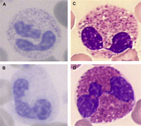 Anomalies Of Granulocytes And Eosinophils In Patient 1 A Patient 1