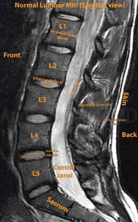 Healthcare Extreme How To Read An Mri Lumbar Spine In 8 Easy Steps