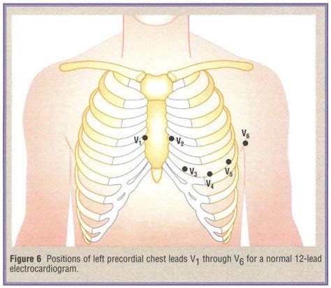 Right Ventricular Infarction Document Gale Academic Onefile