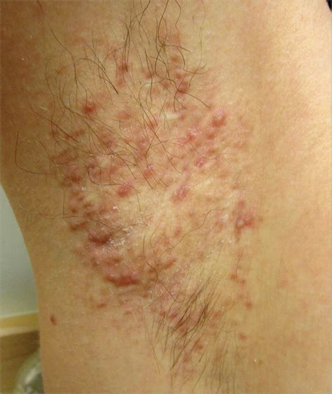 Papules In The Axillae Of A Woman Acne Jama Dermatology Jama Network
