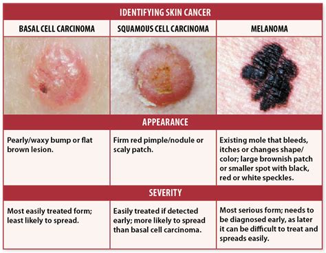 Skin Cancer Signs Self Checks May Help You Avoid Deadly Recurrence University Health News