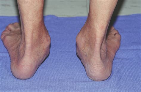Adult Acquired Flat Foot Posterior Tibialis Tendon Dysfunction Kintec