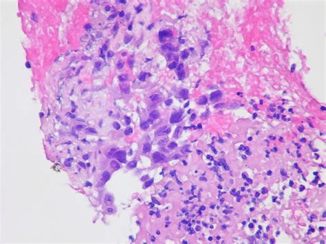 Core Biopsy Squamous Cell Carcinoma Case 244 In This Cas Flickr