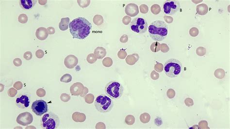 Spherocytes Archives Eclinpath