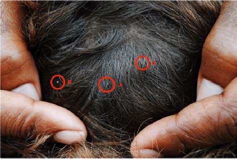 Top 48 Image Lice Eggs In Hair Vn