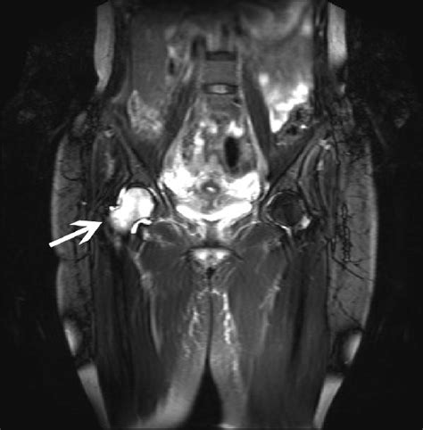 Initial Mri With The Classical Bone Marrow Edema Picture Of The Right