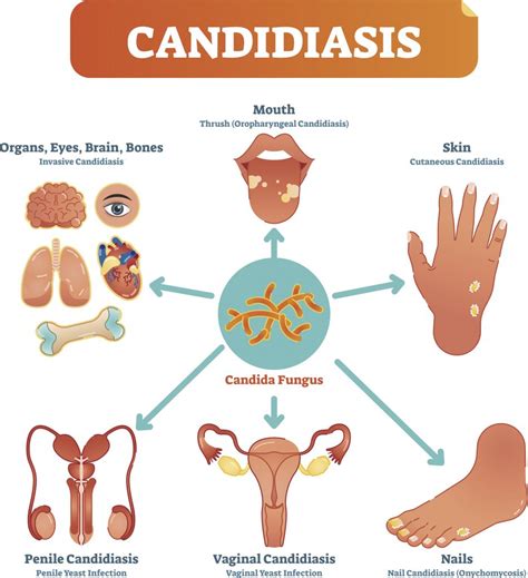 Severity Of Toxic Mold Symptoms Biobalance