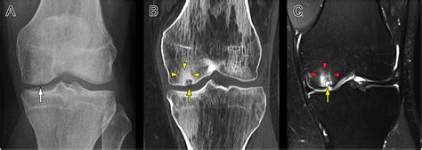 Cyst Formation In The Subchondral Bone Following Cartilage Repair Gao