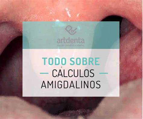 Tonsilolitos O Cálculos Amigdalinos Cáseum Clínica Dental En