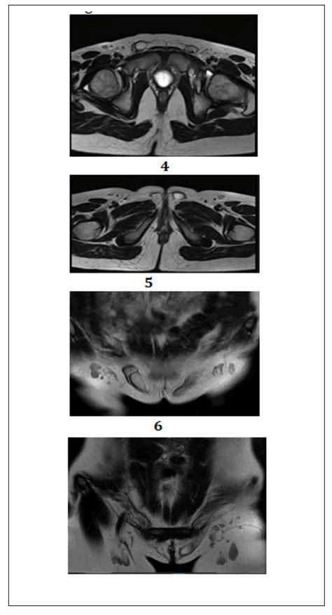 An Interesting Case Of Complete Androgen Insensitivity Syndrome Cais Imaging Features In