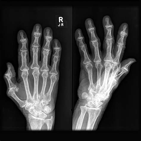 Osteoarthritis Of The Hands Radiology Case