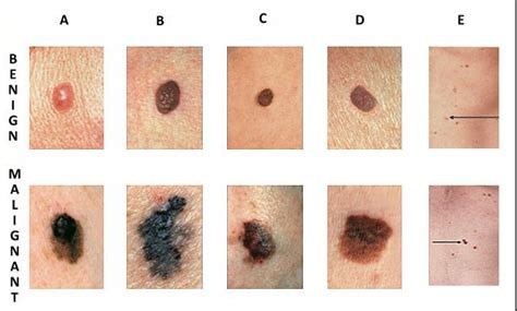 Keep Track Of Moles On The Skin Melanoma Health Exercise And Diet