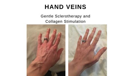 If u need more like this so comment and like. Big Hand Veins and Bulging Arm Veins Treatment - The ...