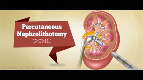 Percutaneous Nephrolithonomy Pcnl New Full Video Youtube