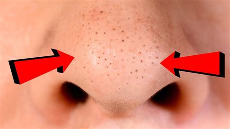 How To Get Rid Of The Blackheads From Skin Naturally Youtube