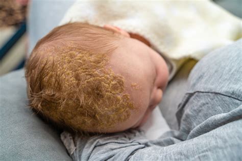Baby Head With Dermatologic Problem Cradle Cap Seborrheic Dermatitis