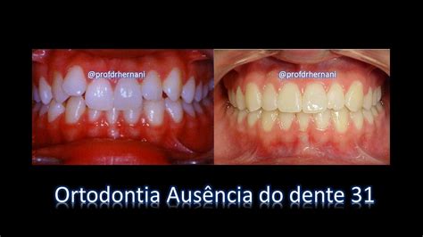 Ortodontia Falta De Um Incisivo Inferior Agenesia Do 31 Youtube