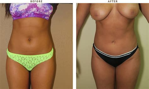 Liposuction Before And After Pictures Dr Turowski Plastic