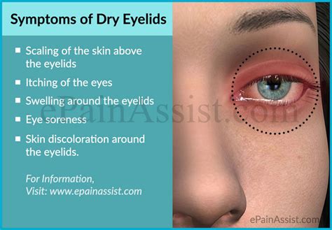 Dry Eyelids Causes Symptoms Treatment