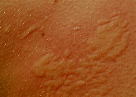 Chlorine Rash Types Pictures Symptoms Cause Treatment