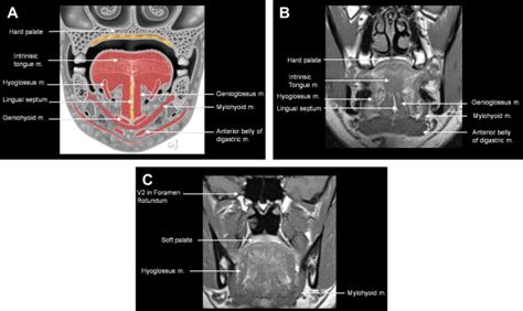 Pitfalls In The Staging Of Cancer Of Oral Cavity Cancer Radiology Key