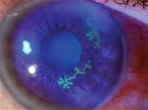 There may also be eye pain, eye redness, and light sensitivity. Herpes Keratitis: Viral Infection Of The Cornea