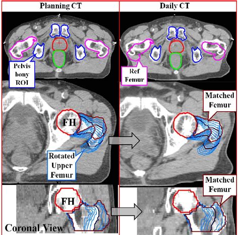 Pelvic Bony Anatomy Used For Ct Registration Top Left And Imported