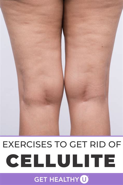 You Dont Have To Be Overweight Or A Certain Age To Get Cellulite In