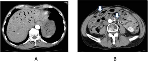 Contrast Enhanced Ct On Admission Revealed Hepatic Portal Vein Gas In