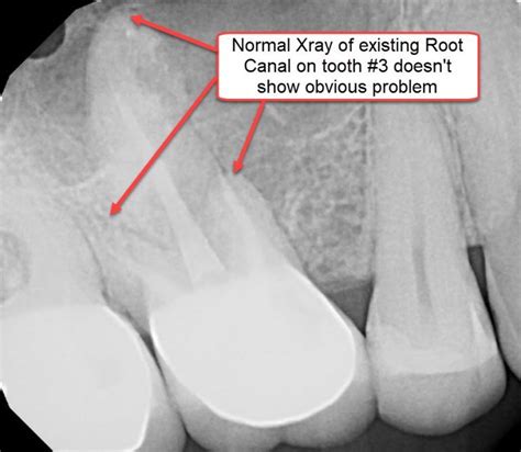 Infected Root Canals And What To Do About Them Integrative Dentistry San Diego Holistic Dentist