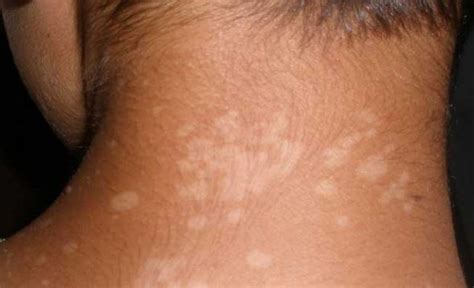 7 Common Causes Of White Spot On Your Skin New Health Advisor