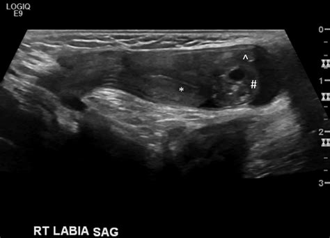 Ultrasound Image Demonstrating A Sagittal View Of The Right Inguinal