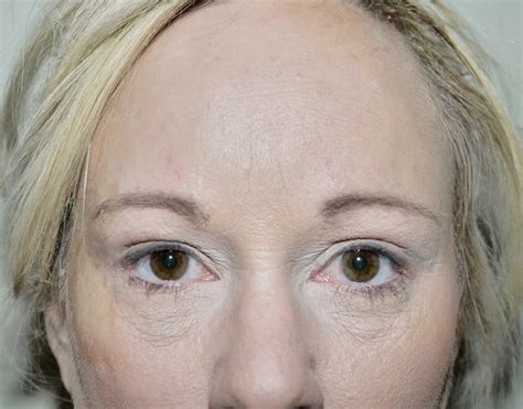 Forehead Lift Desert Hills Plastic Surgery Center