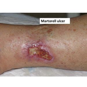 A model of ischemic subcutaneous arteriolosclerosis painful leg ulceration in a poorly controlled hypertensive patient: Post-traumatic ulcer - Elena Conde