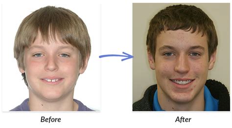 Before And After Braces Photo Delurgio Orthodontics Delurgio Orthodontics