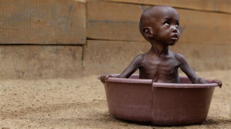 Desnutrición Infantil En África Situación Actual Y Fotos Reales