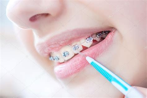Close Up Female Teeth With Braces And Interdental Brush For Dental