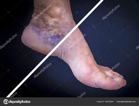Human Foot With Varicose Veins Before And After Stock Photo By ©hriana