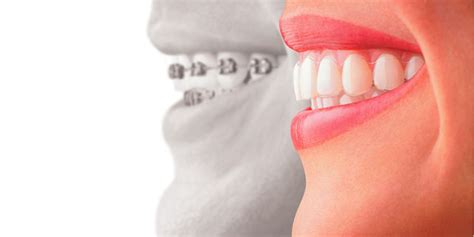 Invisalign Clear Aligners Must Have Aftercare Items
