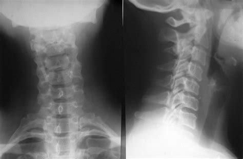 Scoliosis Of The Cervical Spine Symptoms Treatment Exercises Photos