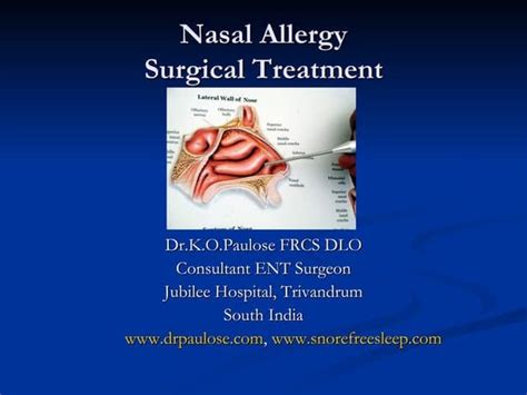 What Is Nasal Turbinate Reduction