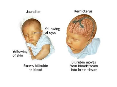 Neonatal Jaundice Indirect Hyperbilirubinemia Of The Newborn