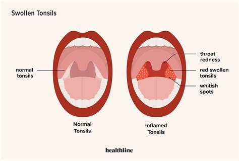 Swollen Tonsils Tonsillitis Symptoms Causes And More Throat