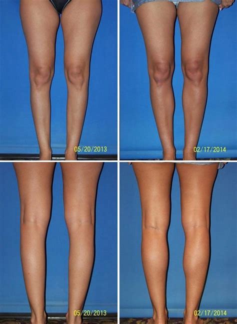 Calves Before And After