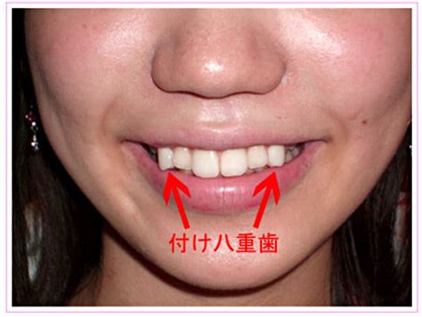 In Japan A Trend To Make Straight Teeth Crooked Noticed The New York Times