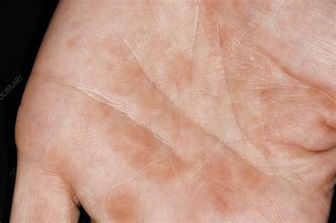Hand After Psoriasis Treatment Stock Image C0090106 Science