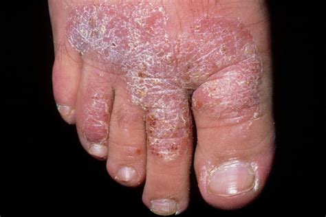 Psoriasis Variants And Related Conditions
