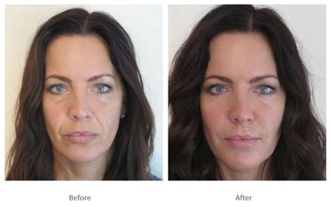 Chin Filler Before And After The Cosmetic Skin Clinic