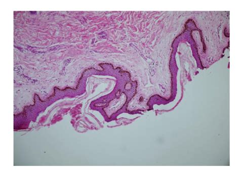 Hyperkeratosis Papillomatous Mild Acanthosis In The Epidermis And